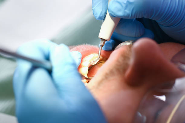 Best Emergency Wisdom Teeth Removal in The Pinehills, MA